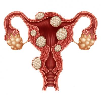 Endometriosis Facts